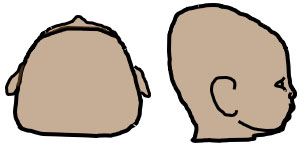 drawing of Brachycephaly viewed from top and side of head